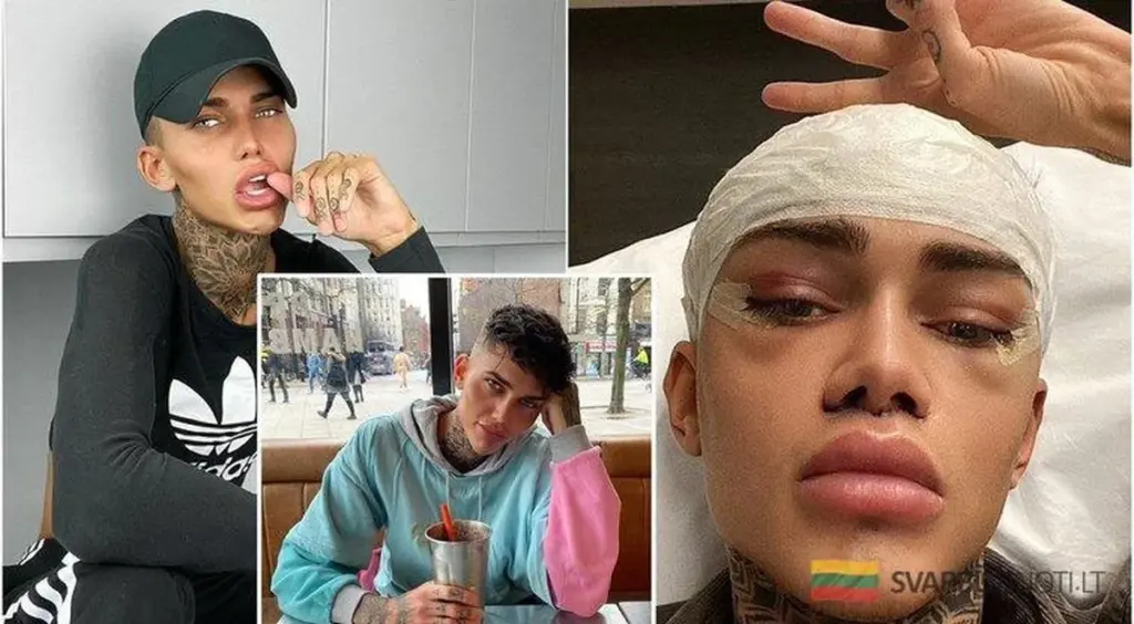 Chłopak wydał fortunę, by upodobnić się do filtra z Instagrama. Teraz wygląda jak z horroru