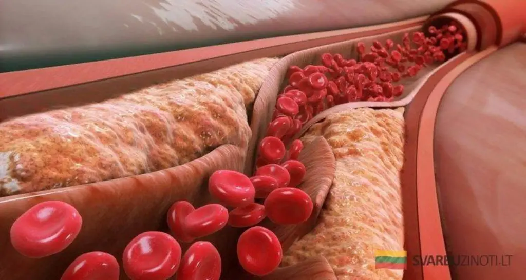 Dlaczego cholesterol cię zabija: Amerykański lekarz ujawnia szokujące fakty