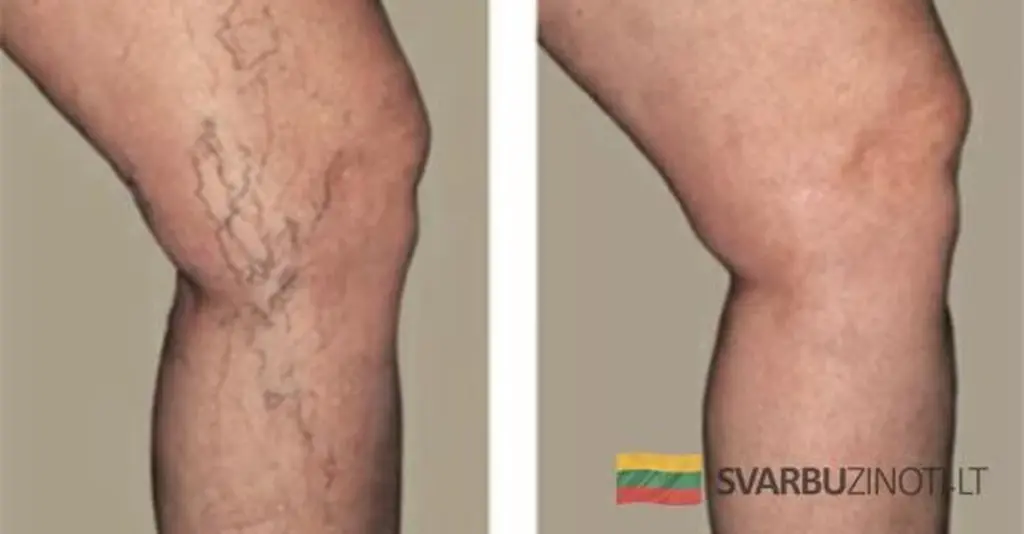 5 sposobów, by Twoje nogi nigdy nie poznały żylaków