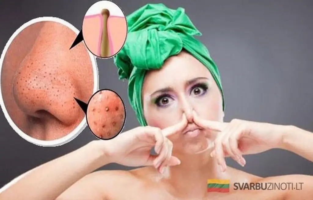 Prosty trik, który sprawi, że zapomnisz o wypryskach na zawsze