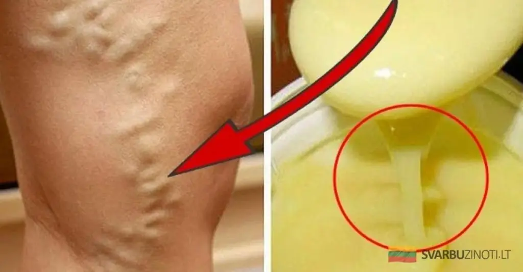 Zapomnij o żylakach: domowy cud-maść, która zaskoczy skutecznością